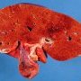 Hepatic necrosis in adenoviral hepatitis
