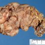Plexiform neurofibroma in neurofibromatosis type 1 (NF1)