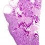 Renal cortical cysts