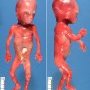 Turricephaly by intracranial neuroectodermal cyst
