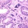 Stromal Hyperplasia with Atypia