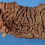 Colectomy of ulcerative colitis