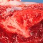 Old focal placental infarct