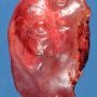Focal nodular hyperplasia
