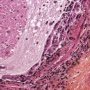 Proteinaceous material in a bronchiole