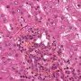 Acute cholangitis