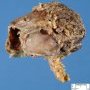 Abdominal cystic lymphangioma