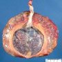 Placenta circumvallata