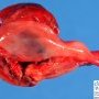 Tubal rupture during tubal pregnancy