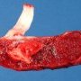 Old focal placental infarct