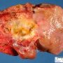 Kasai procedure in extra-hepatic biliary tract atresia