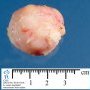Mammary hamartoma