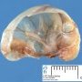 Spermatocele