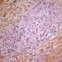 Dermal epithelioid granulomas