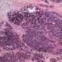 Desmoplastic small round cell tumor (DSRCT)