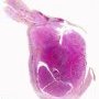 Testicular torsion