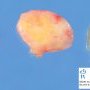 Section of a schwannoma