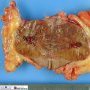 Renal oncocytoma