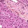 Lipofuscin in portal macrophages