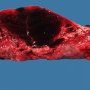 Subchorial hematoma