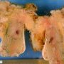 Chondroblastoma