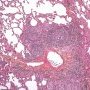 Pulmonary nodular lymphoid hyperplasia
