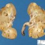 Small Wilms tumor at the superior pole
