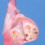 Testicular juvenile-type granulosa tumor