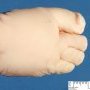 Foot oligodactyly