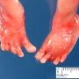 First toe deviation in oligohydramnios sequence