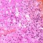 Autoimmune hepatitis