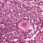 Yolk sac tumor