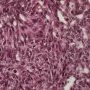 Abdominal desmoplastic small round cell tumor