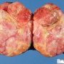 Massive WIlms tumor