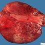 Mesenteric cystic lymphangioma