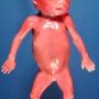 Hydrocephaly in a 21 weeks fetus