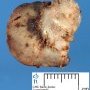 Pulmonary metastasis of an osteosarcoma