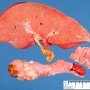Splenic hypoplasia in severe sepsis