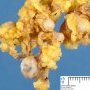 Desmoplastic round cell tumor in epiploon