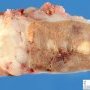 Multiple testicular adenomas in androgen insentivity syndrome