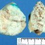 Lingual lymphangioma