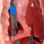 Bilateral congenital diaphragmatic hernia