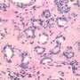 Post-atrophic Hyperplasia - Higher Magnification