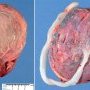 Circumvallate placenta (with control)