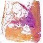 Plexiform fibrohistiocytic tumor