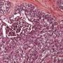 Abdominal desmoplastic small round cell tumor