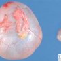 Ovarian serous cystadenoma