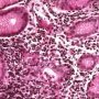 Acute glandulitis in active focal gastritis