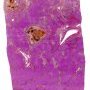 Biliary plugs in bile ducts in extrahepatic biliary tract atresia with (...)