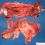 Splenic mesothelial cyst (open)